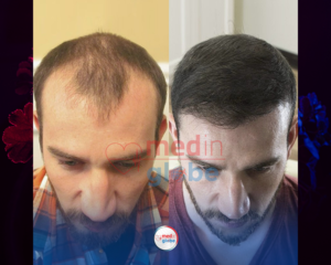 hair-transplant-istanbul-turkey