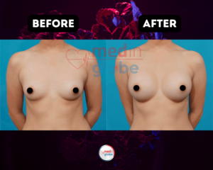 breast-surgery-istanbul-turkey-medinglobe